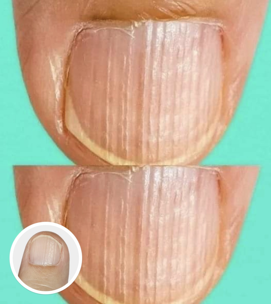 What Those Small Ridges on Your Nails Really Mean