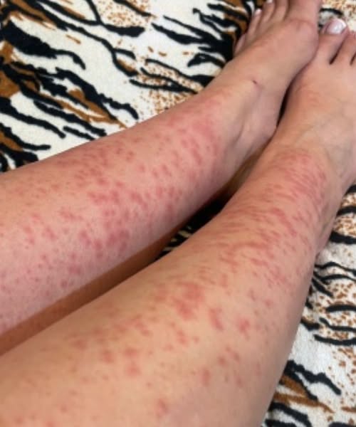 When a Temporary Stay Turns Itchy: What to Know About Mysterious Bites