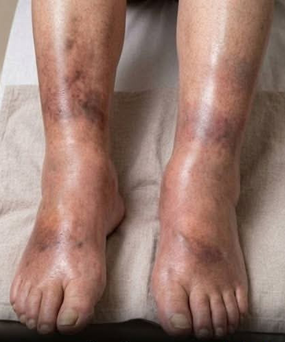 When the Body Sends Subtle Signals: Understanding Unexplained Leg Swelling