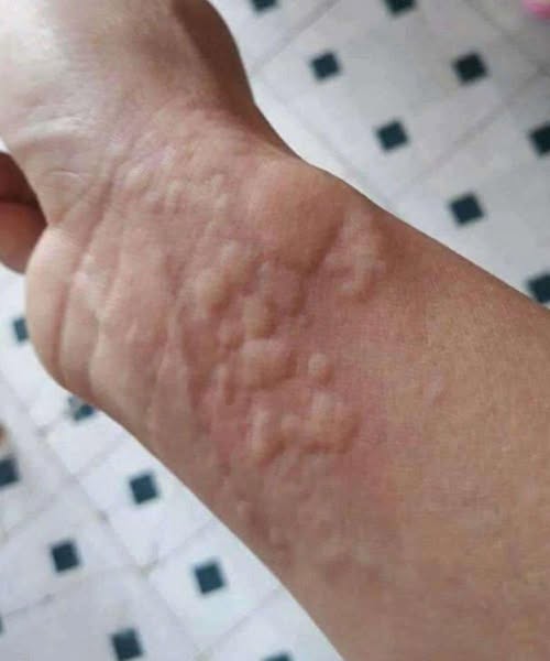 When Hives Signal More Than Skin Deep: Recognizing a Serious Allergic Reaction