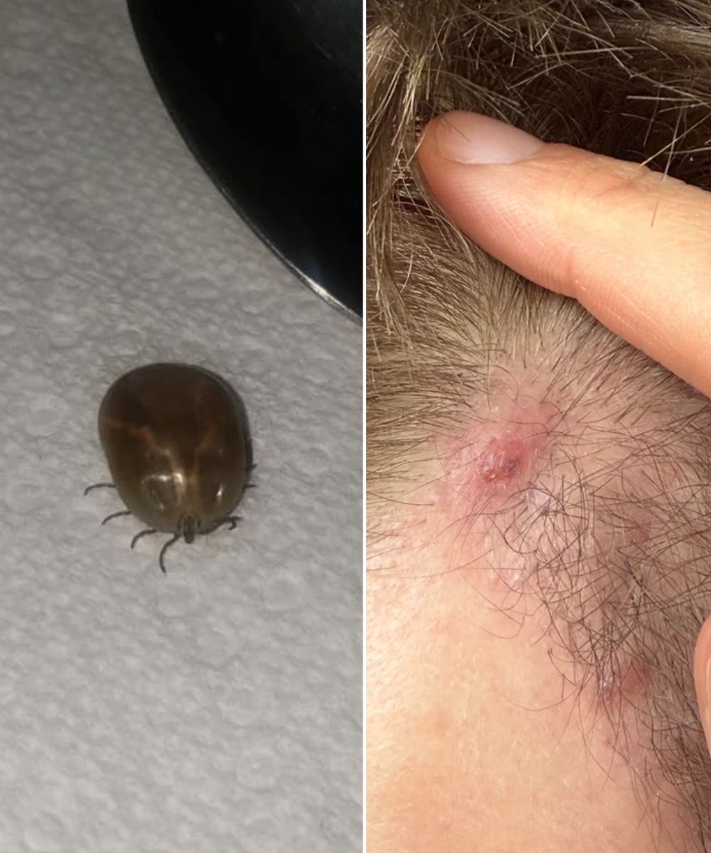 Tick Bites Explained: What to Know, What to Watch For, and How to Stay Safe