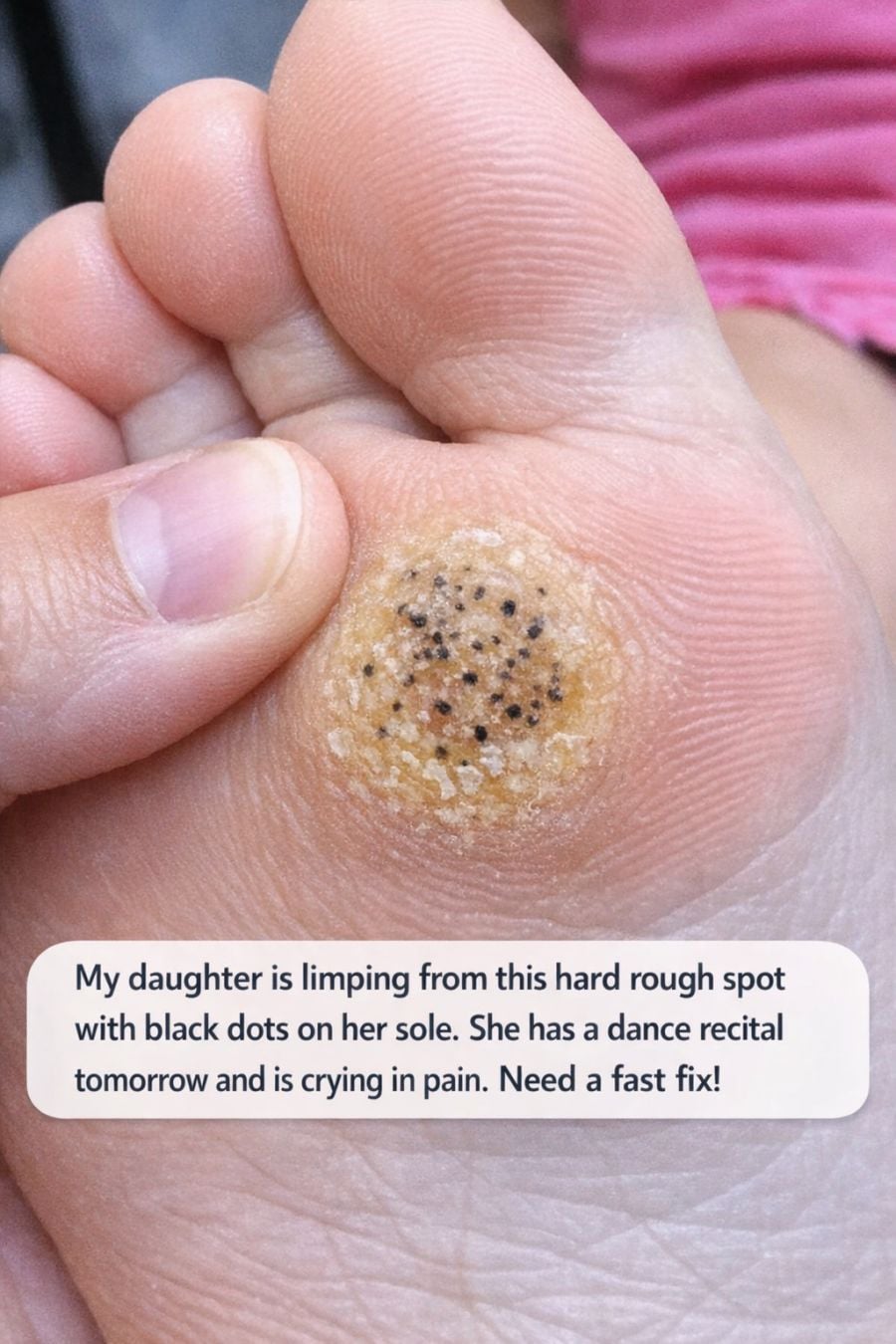 How to Help Your Child Manage a Painful Plantar Wart Before an Event