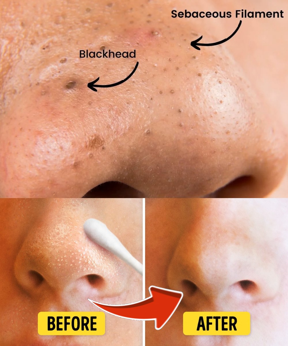 A Simple Skincare Routine for Managing Blackheads at Home