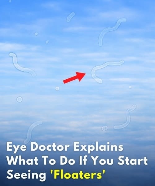 Eye Floaters: When to Monitor Them and When to Seek Immediate Care